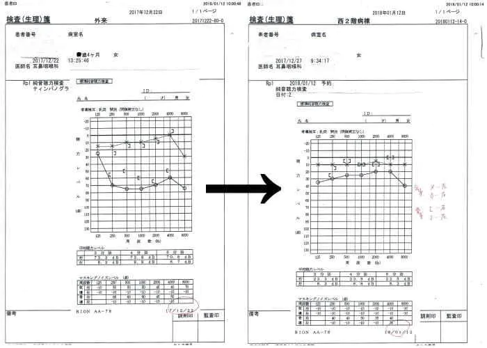 聴力検査