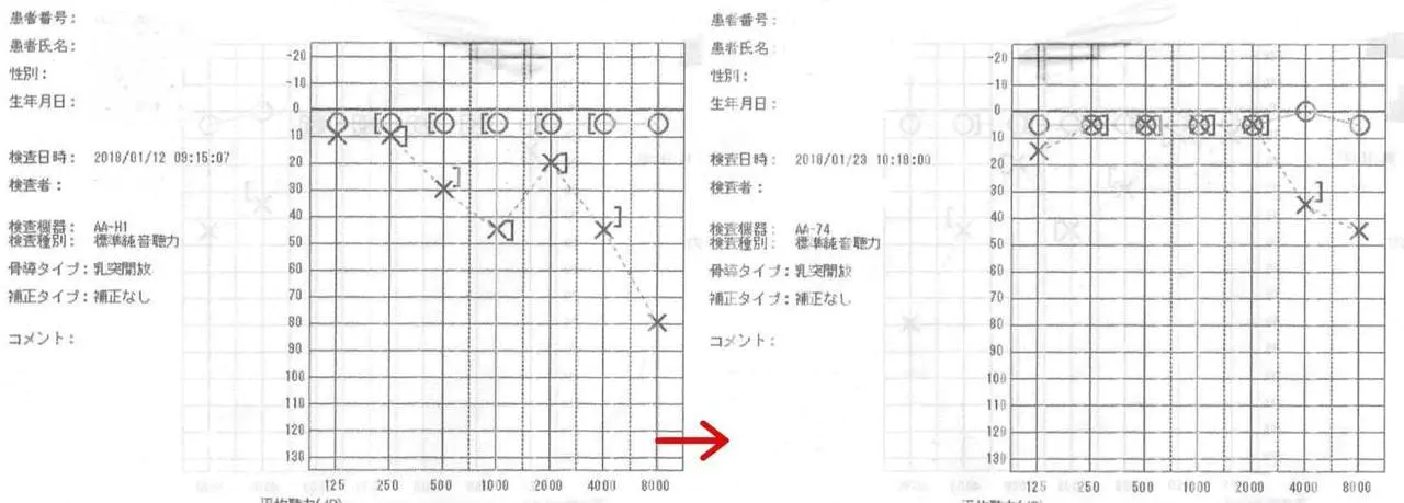 聴力検査